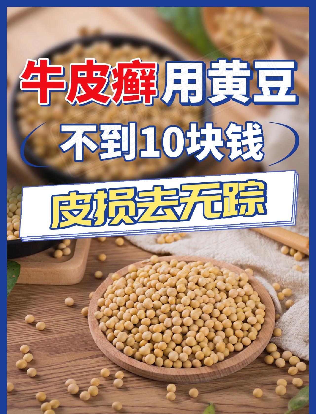 治疗牛皮癣特效偏方