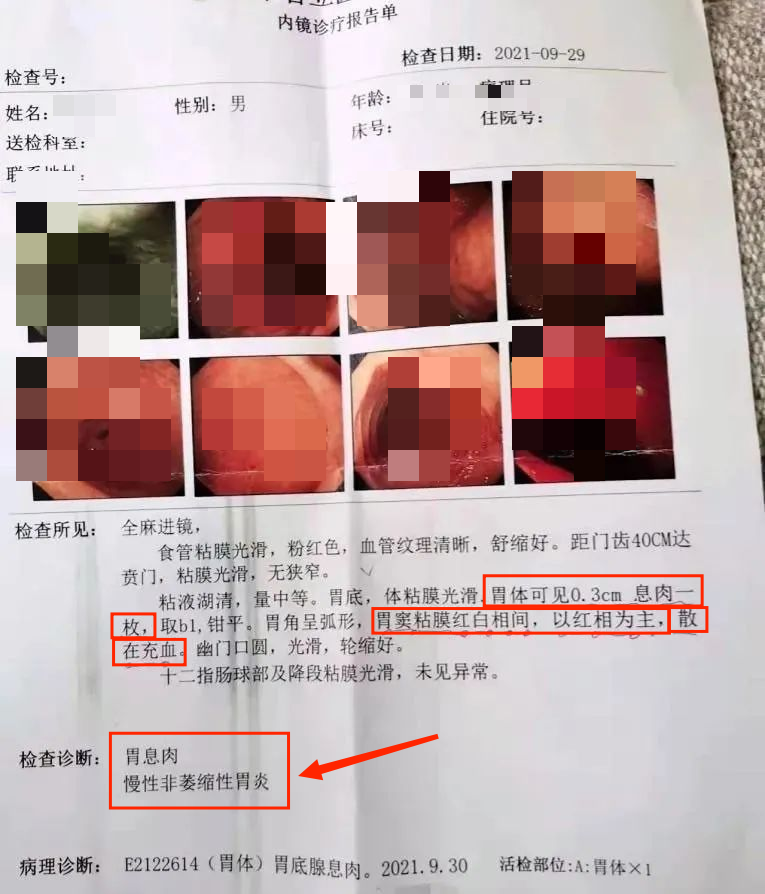 胃息肉手术后多久恢复?