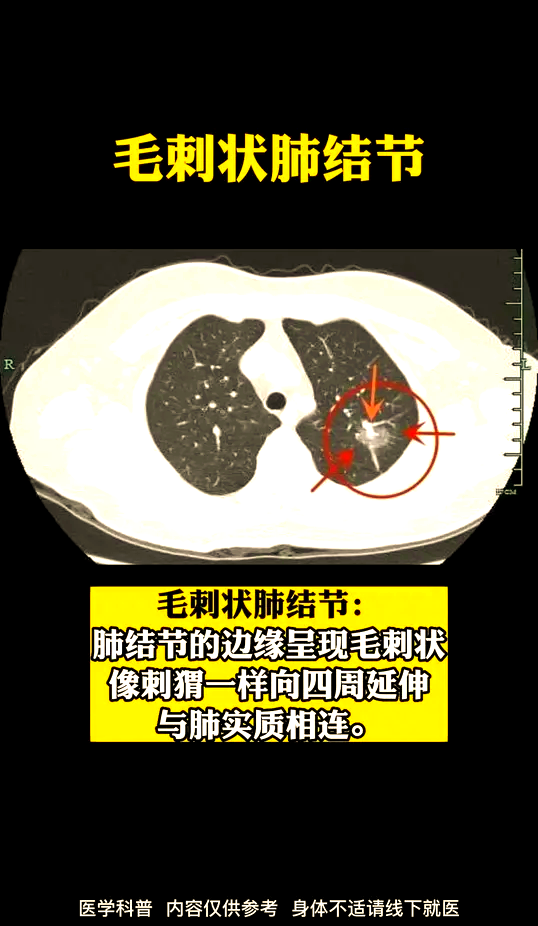 右肺结节是什么意思