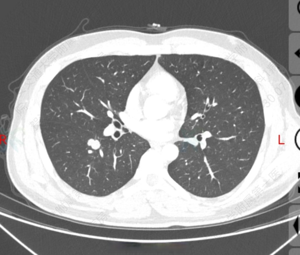 右肺结节是什么意思