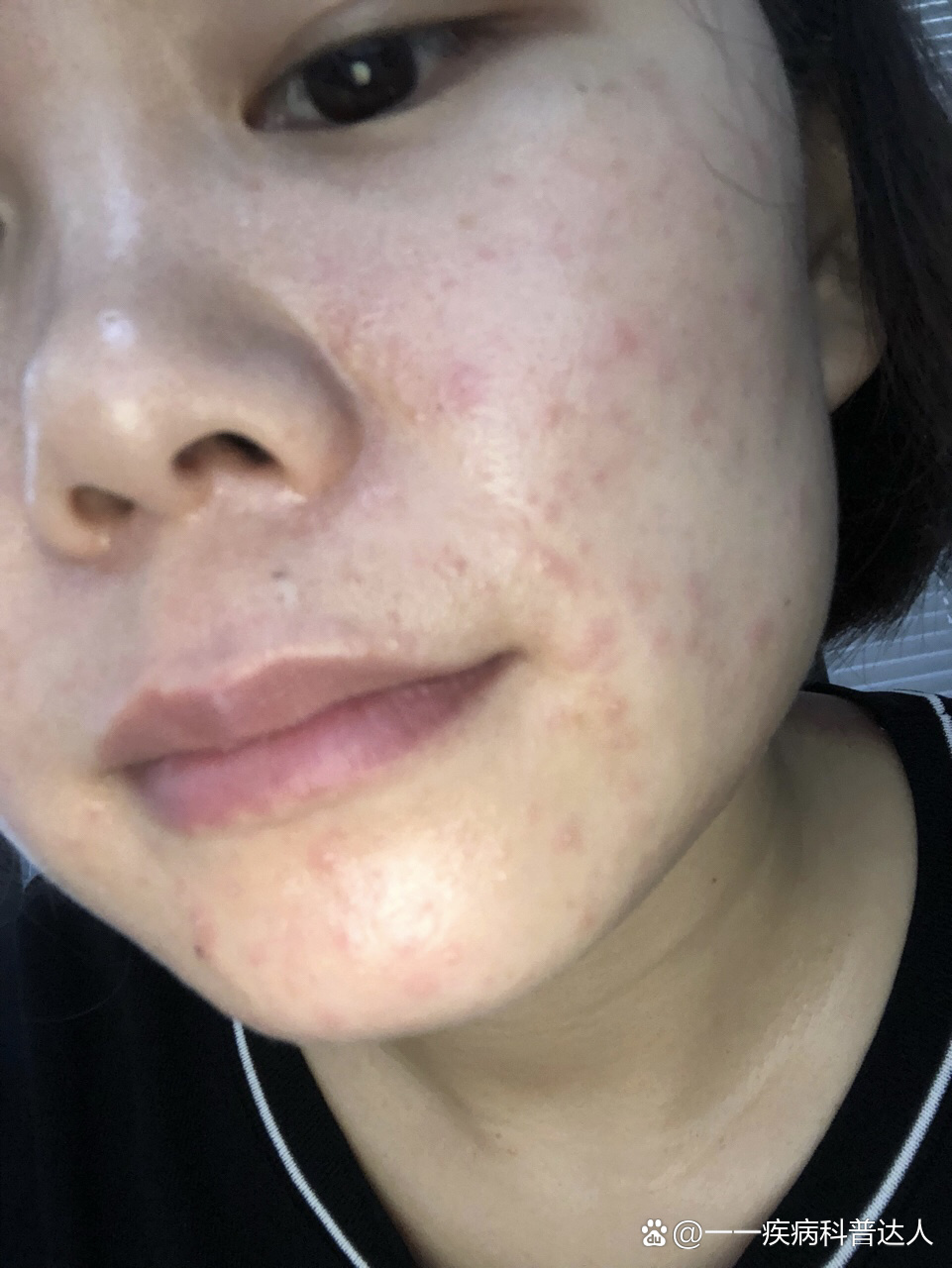 脸上脂溢性皮炎,大夫给开了涂他克莫司软膏