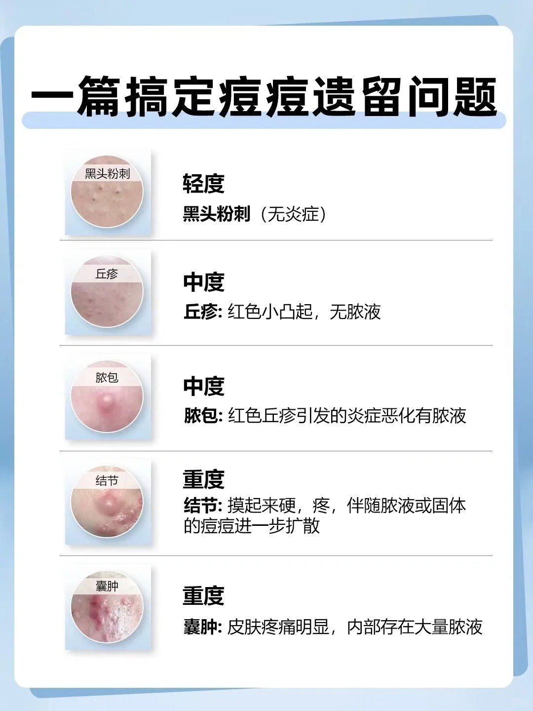 脸上长痤疮的原因有哪些