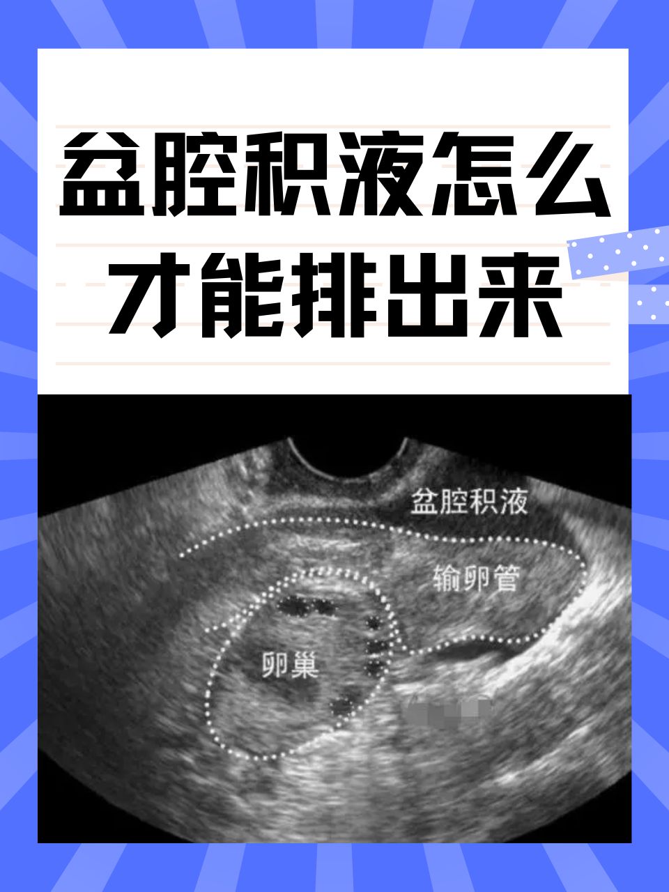 盆腔积液是怎么一回事