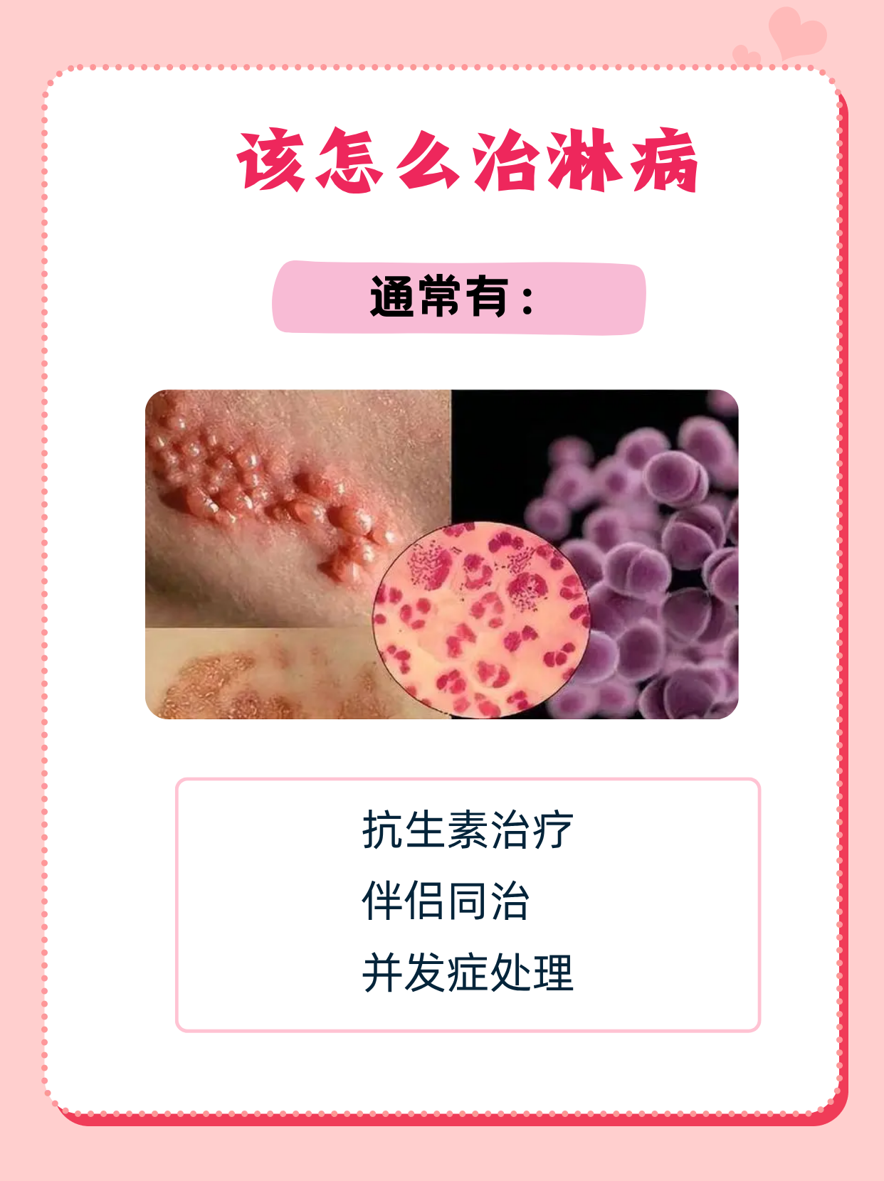 淋病主要是怎么治疗