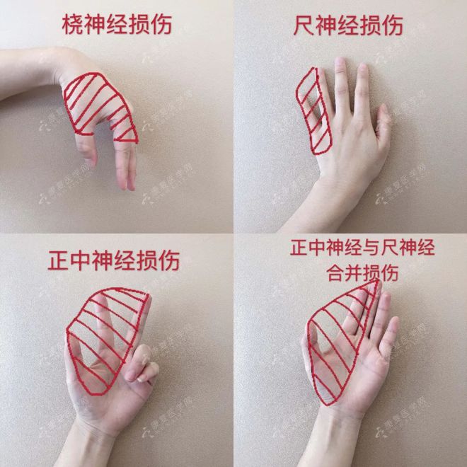 正中神经损伤怎么办