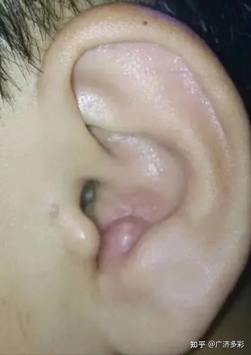 耳朵里面长痘痘怎么治疗