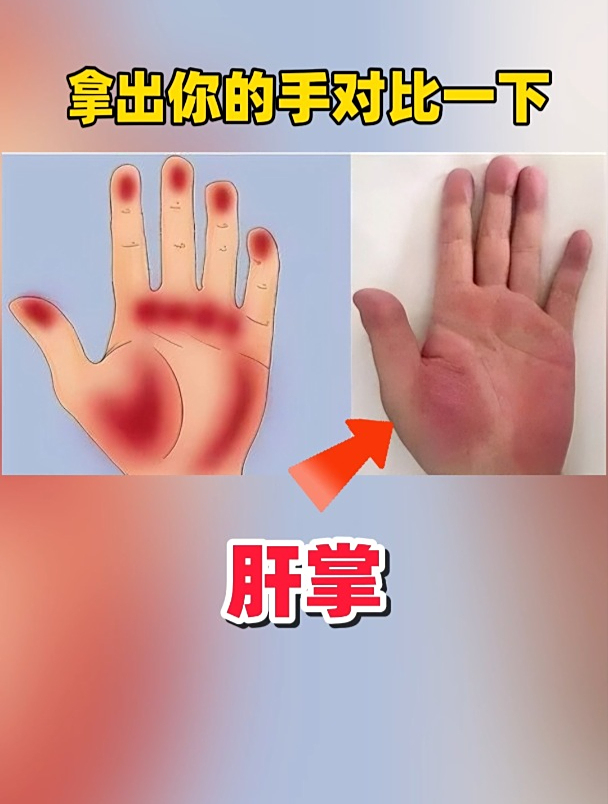 肝掌与正常手掌的区别有哪些