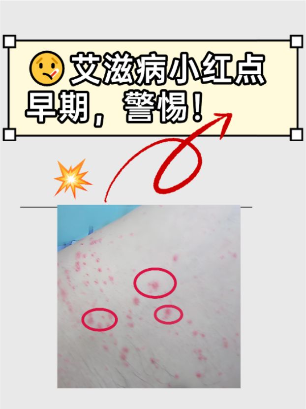 艾滋病初期淋巴结肿大有什么特点?