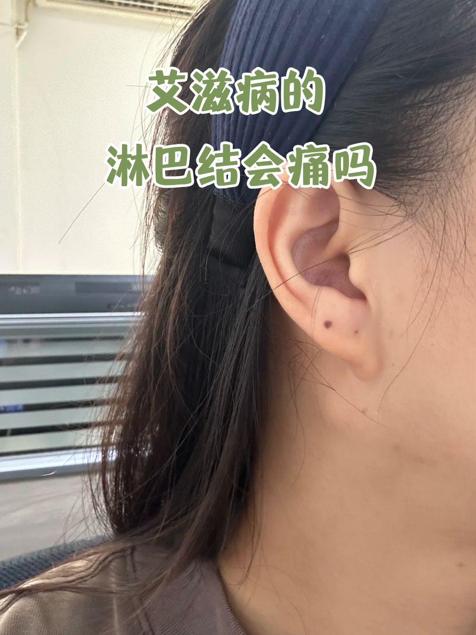 艾滋病初期淋巴结肿大有什么特点?