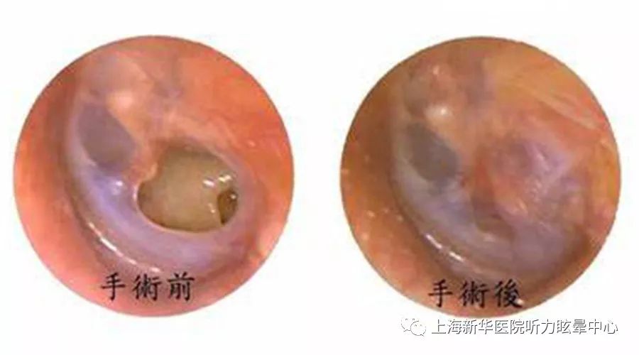 鼓膜穿孔严重吗