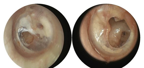 鼓膜穿孔严重吗