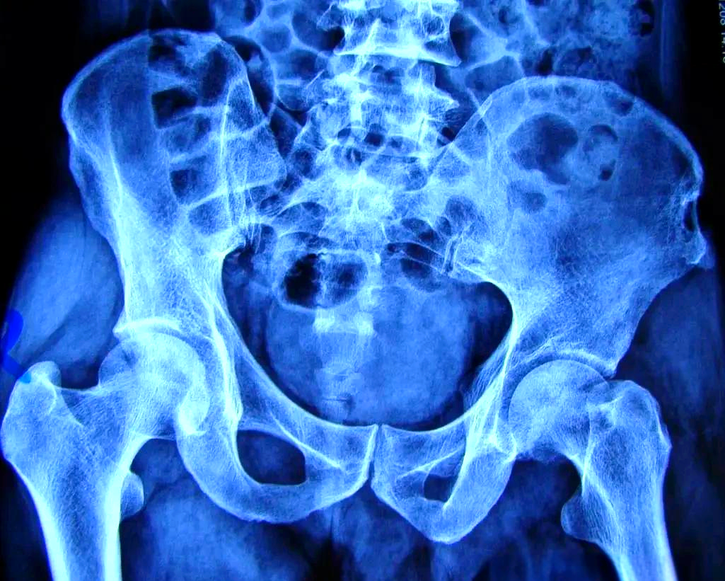 骨结核能治愈吗?