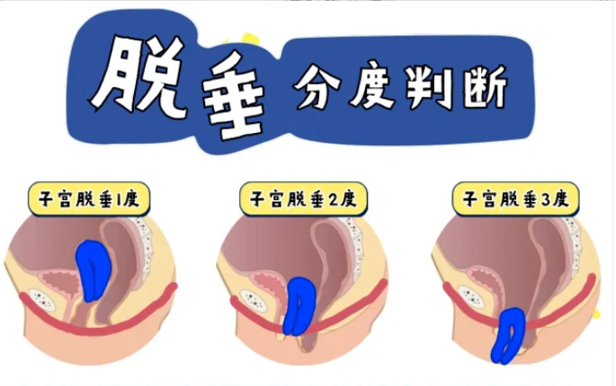 子宫下垂的症状有哪些