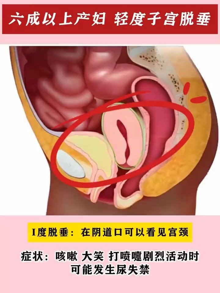 子宫下垂的症状有哪些