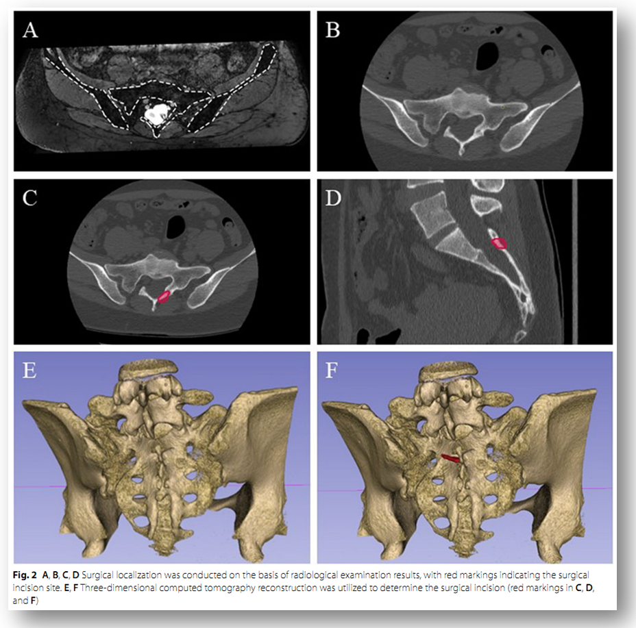 骶管囊肿怎么治彻底