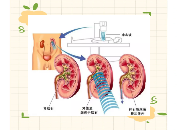 体外震波碎石术有什么风险