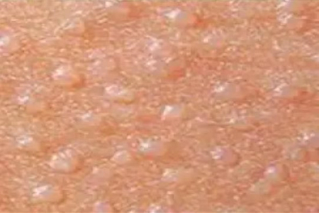 包皮上长了一些小颗粒