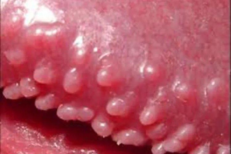 包皮上长了一些小颗粒