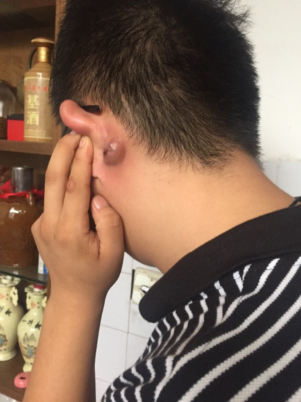 耳朵后面长了个硬疙瘩