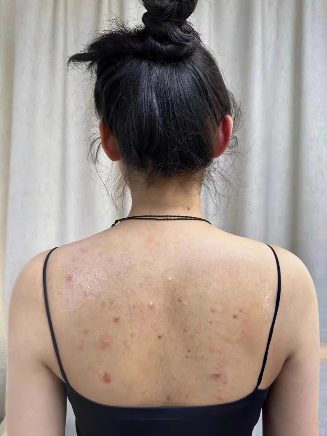 后背上的小疙瘩,特别痒