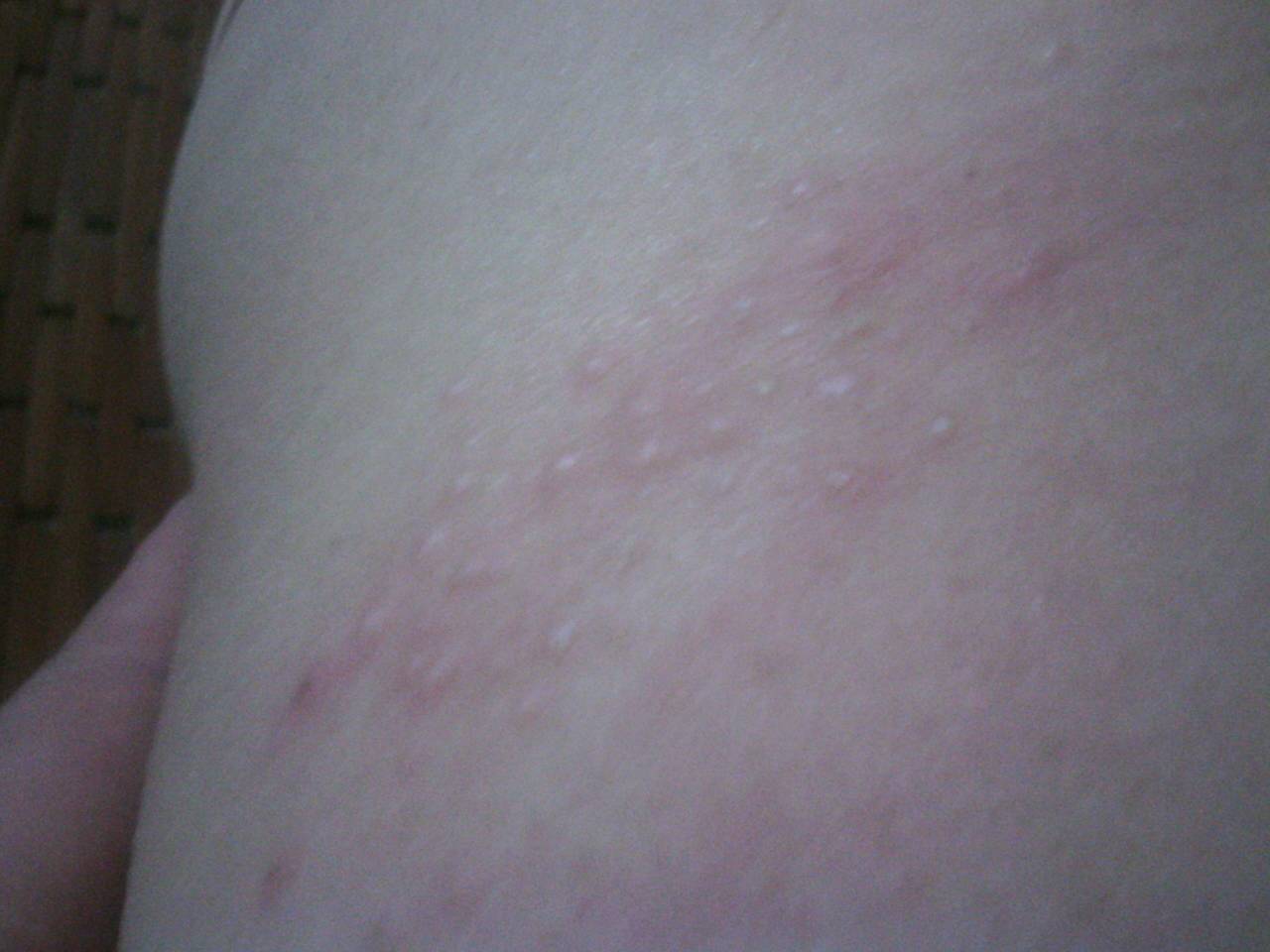 后背上的小疙瘩,特别痒