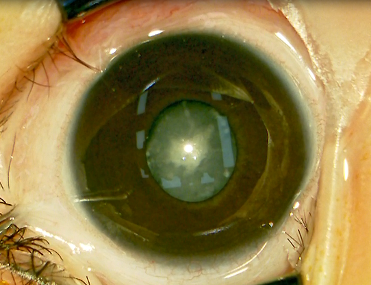 先天性白内障怎么回事