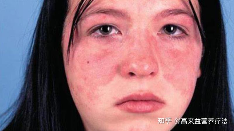 红斑狼疮快死时的反应