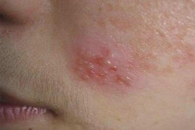 红斑狼疮快死时的反应