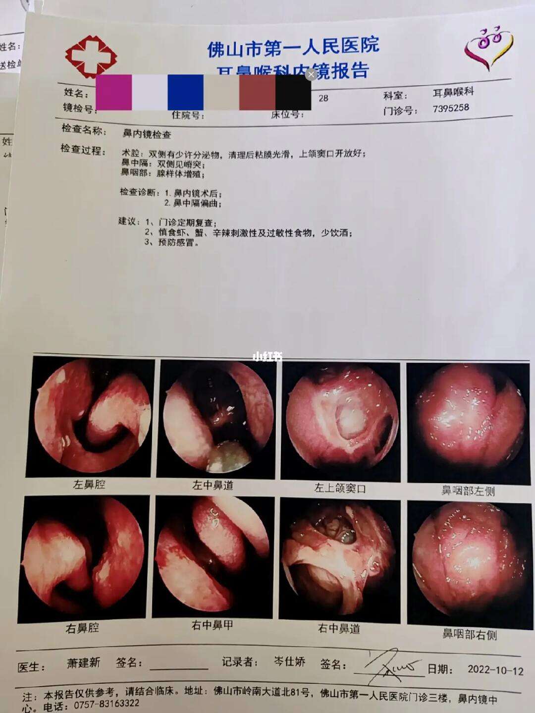 鼻窦炎手术一般多少钱