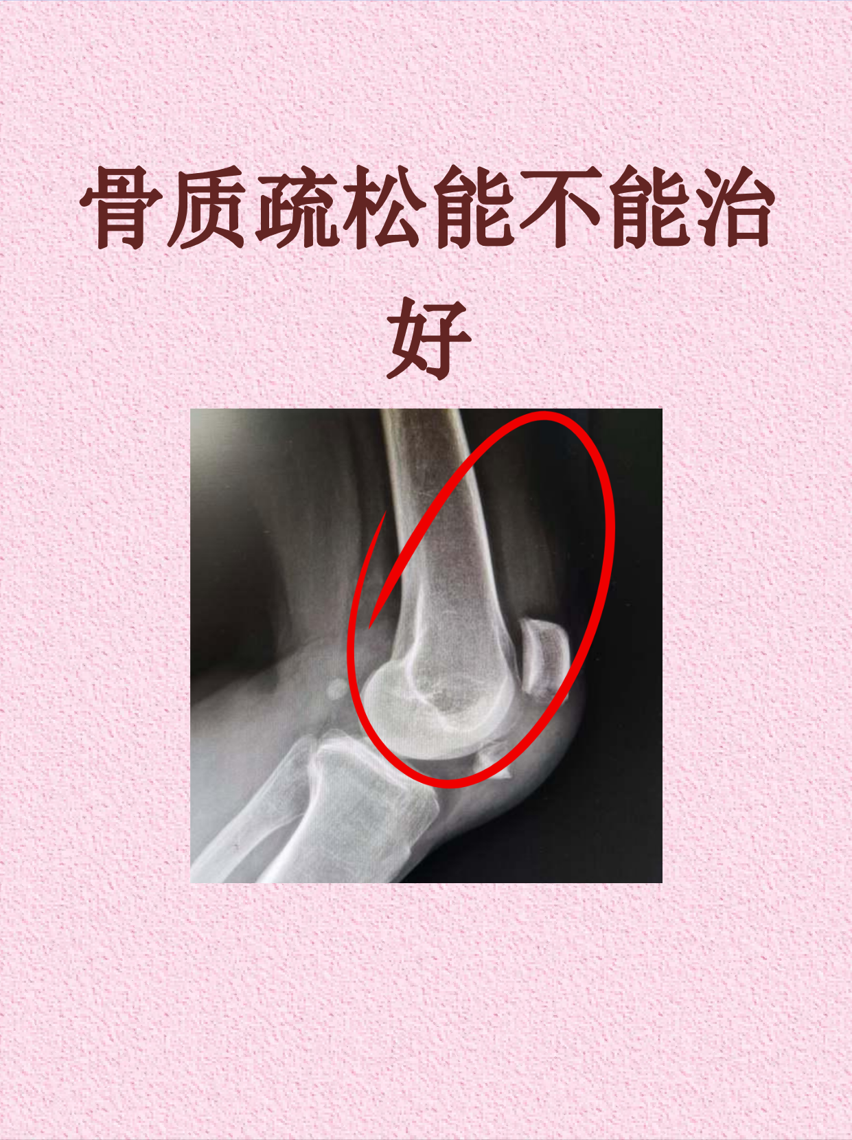 骨质疏松能治好吗