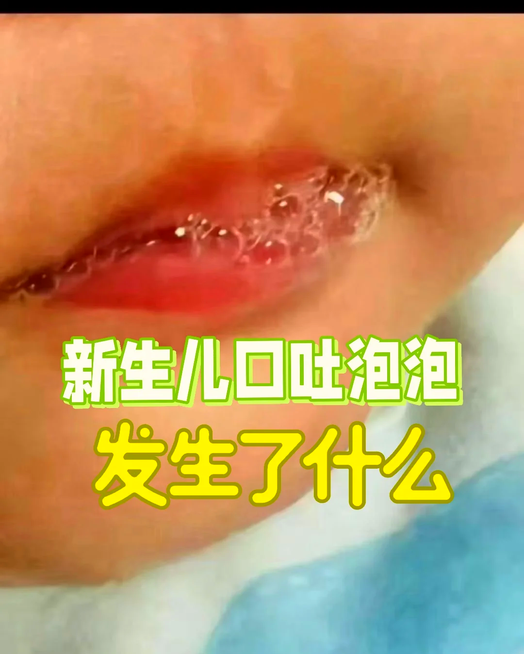 一月新生儿嘴巴里面有白泡
