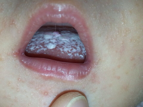 一月新生儿嘴巴里面有白泡