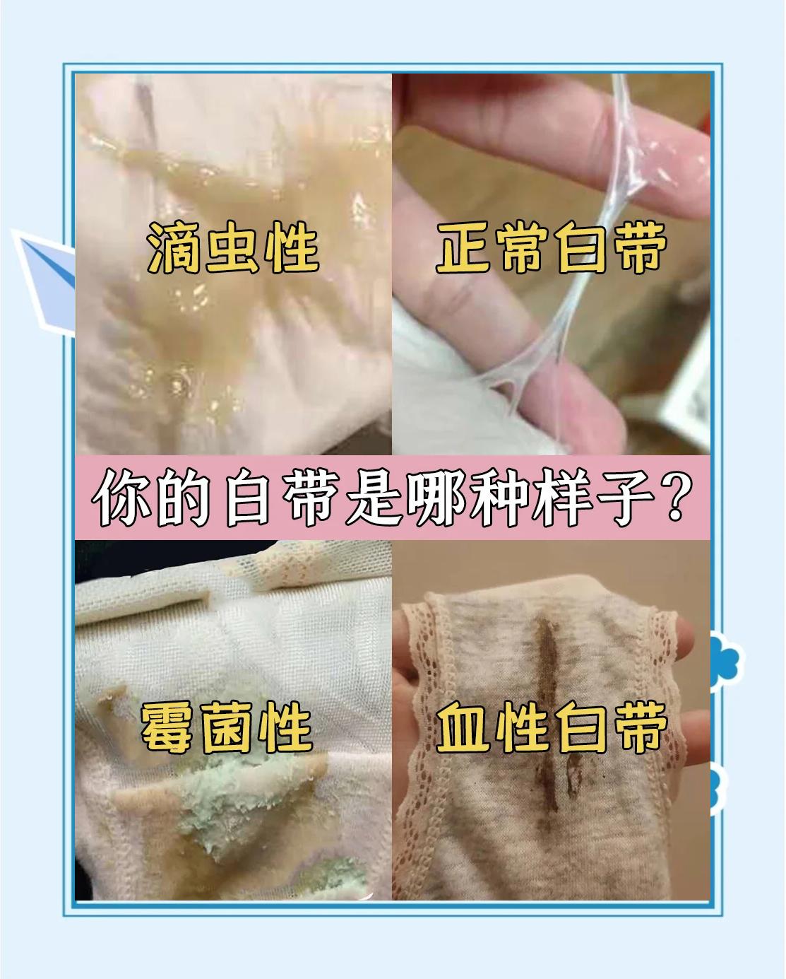 月经推迟白带发黄怎么回事