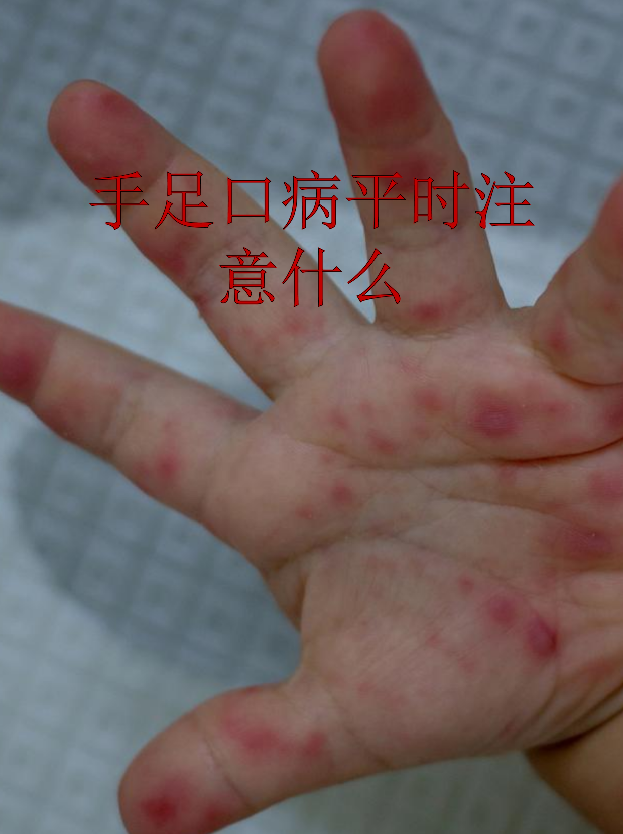 儿童手足口病初期症状特征有哪些