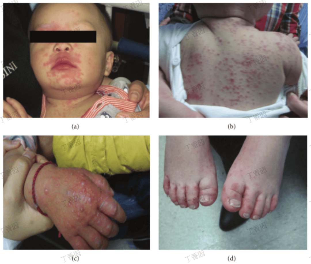 儿童手足口病初期症状特征有哪些