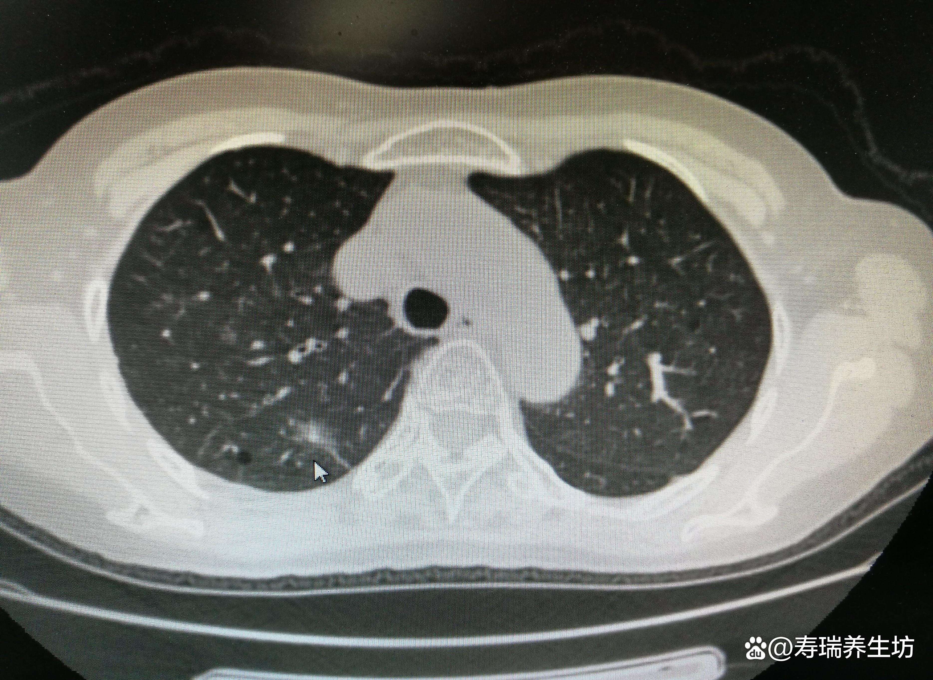 6mm肺部结节一年后没了是怎么回事