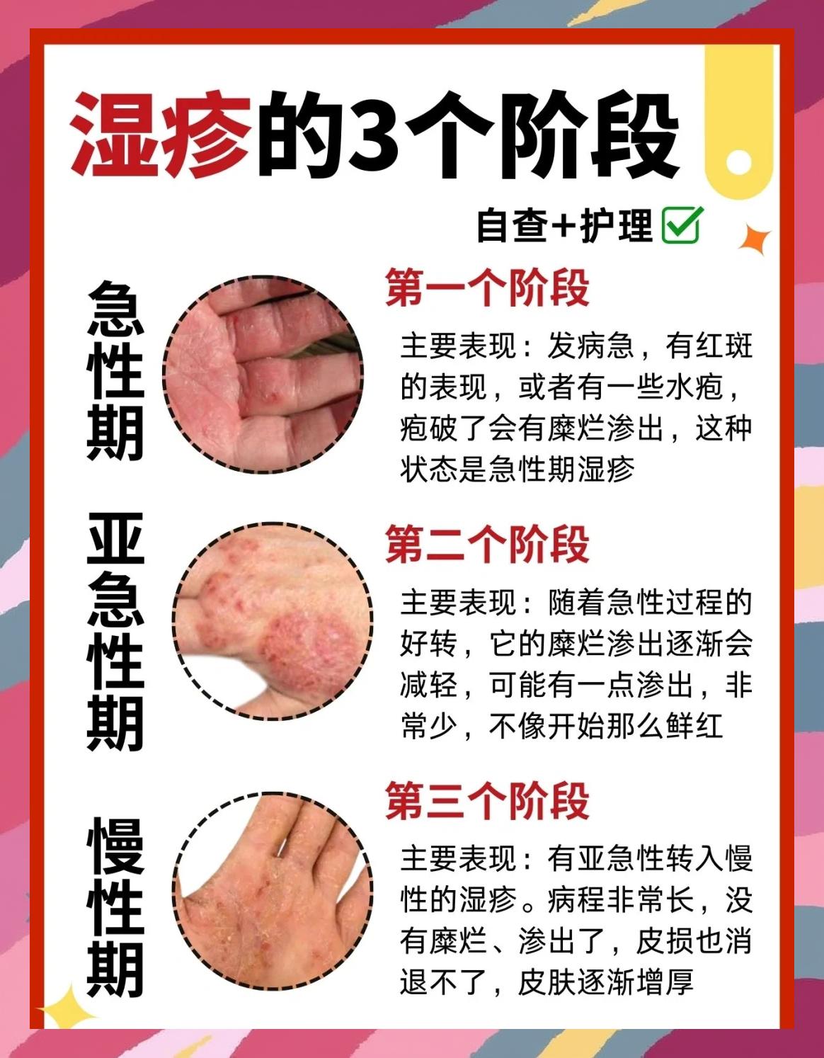 治湿疹的最好方法