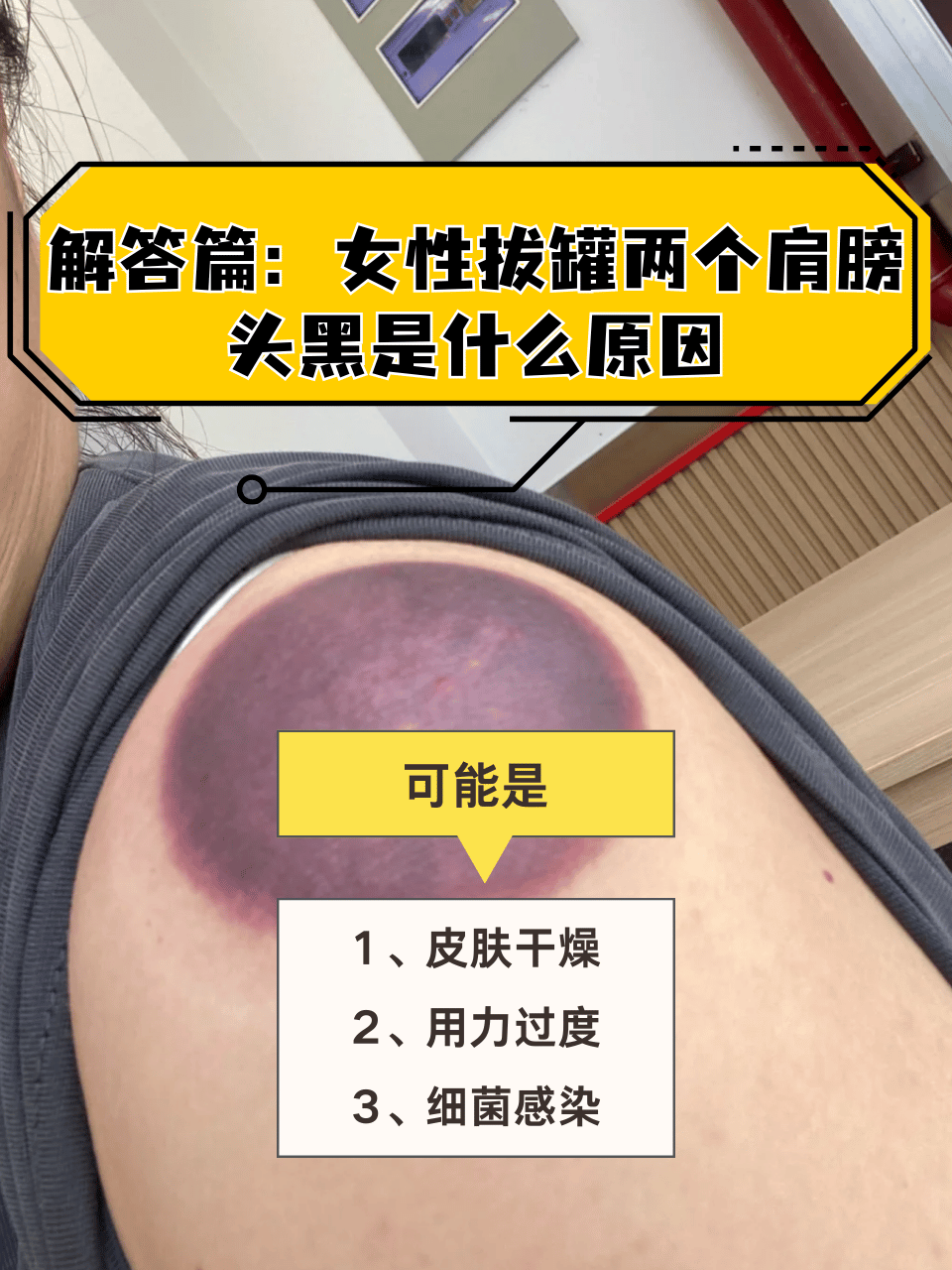 拔罐后黑紫怎么回事