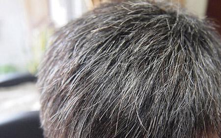 少白头是怎么回事