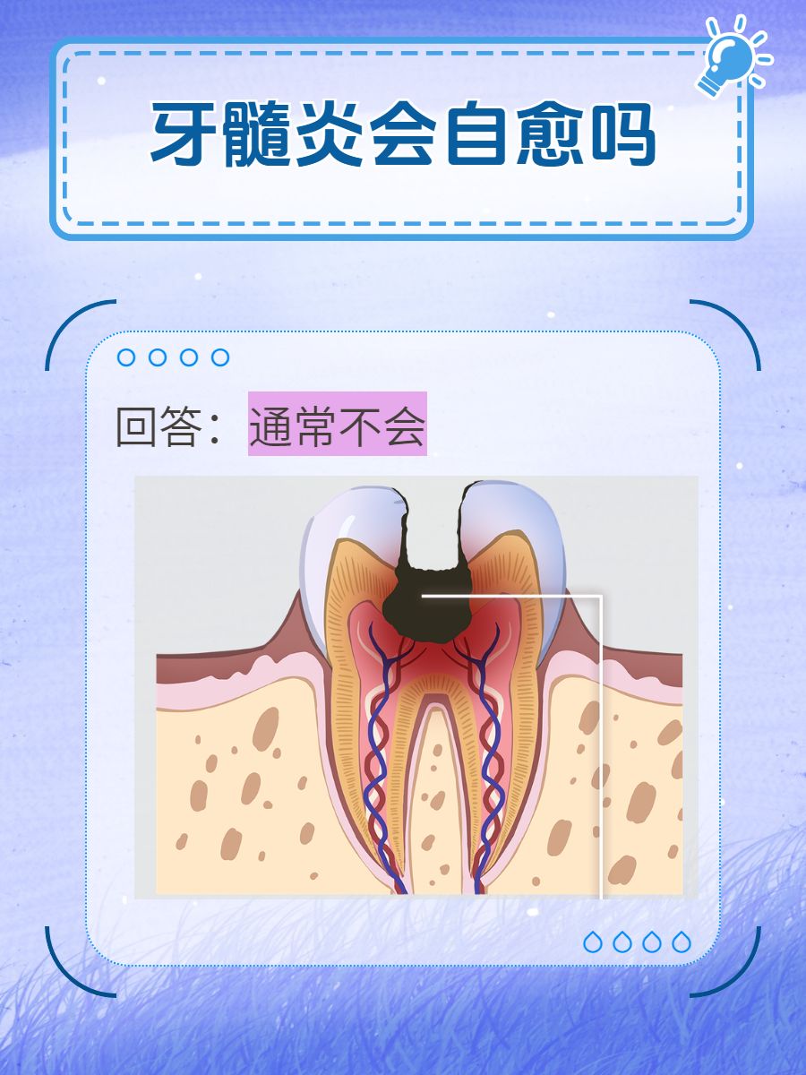 急性牙髓炎的症状有哪些?