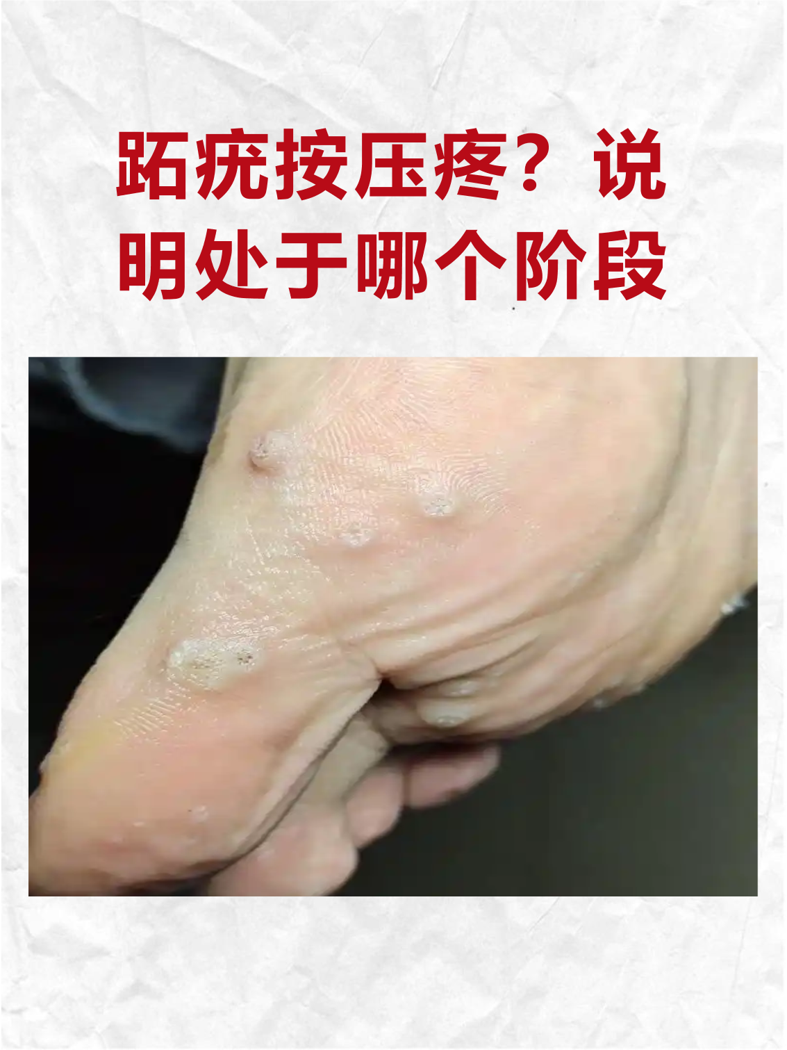 脚上长了个骺子怎么办