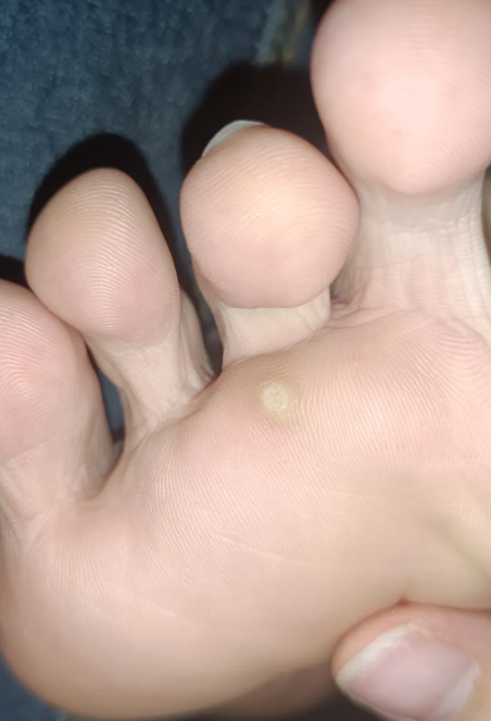 脚上长了个骺子怎么办