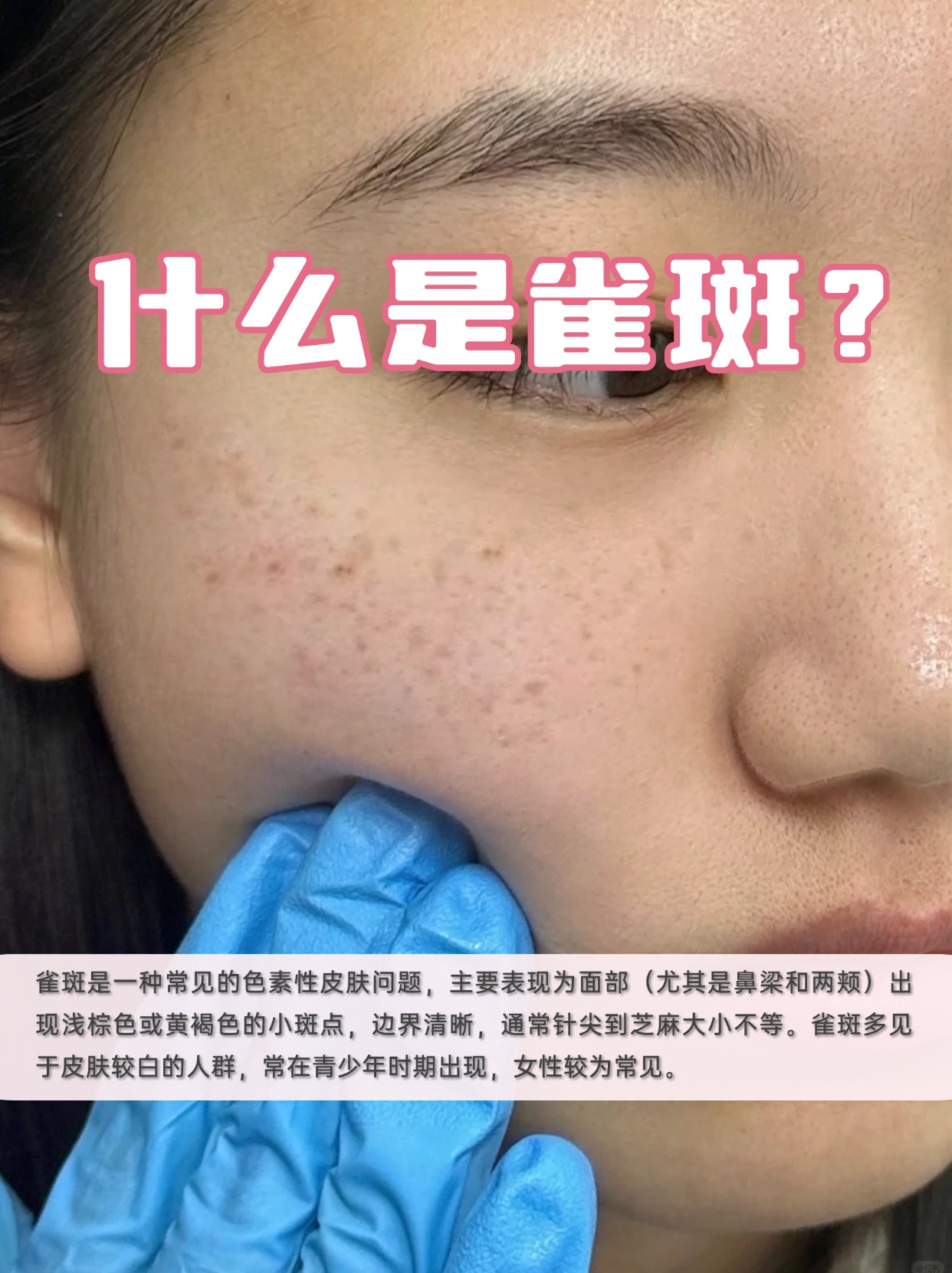 脸上有雀斑什么原因