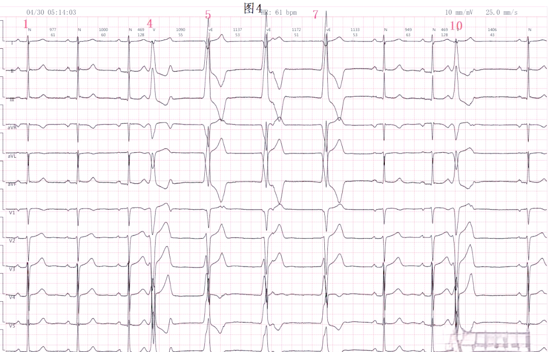 室性心动过速的心电图