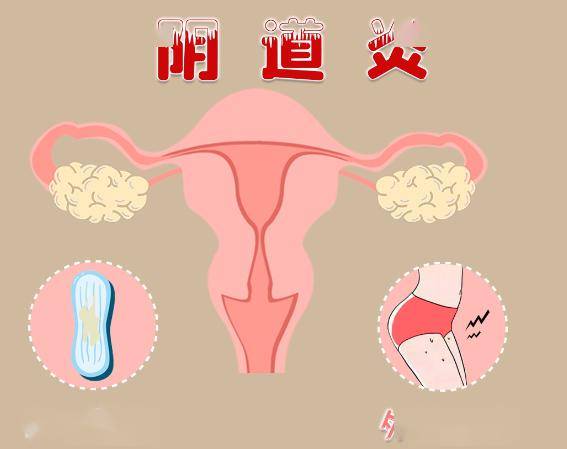 阴道炎是什么?