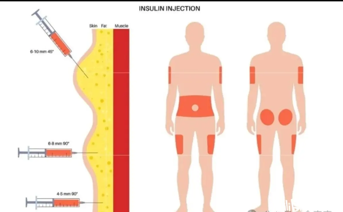 突然大腿中段外侧有一横向肌肉凹陷