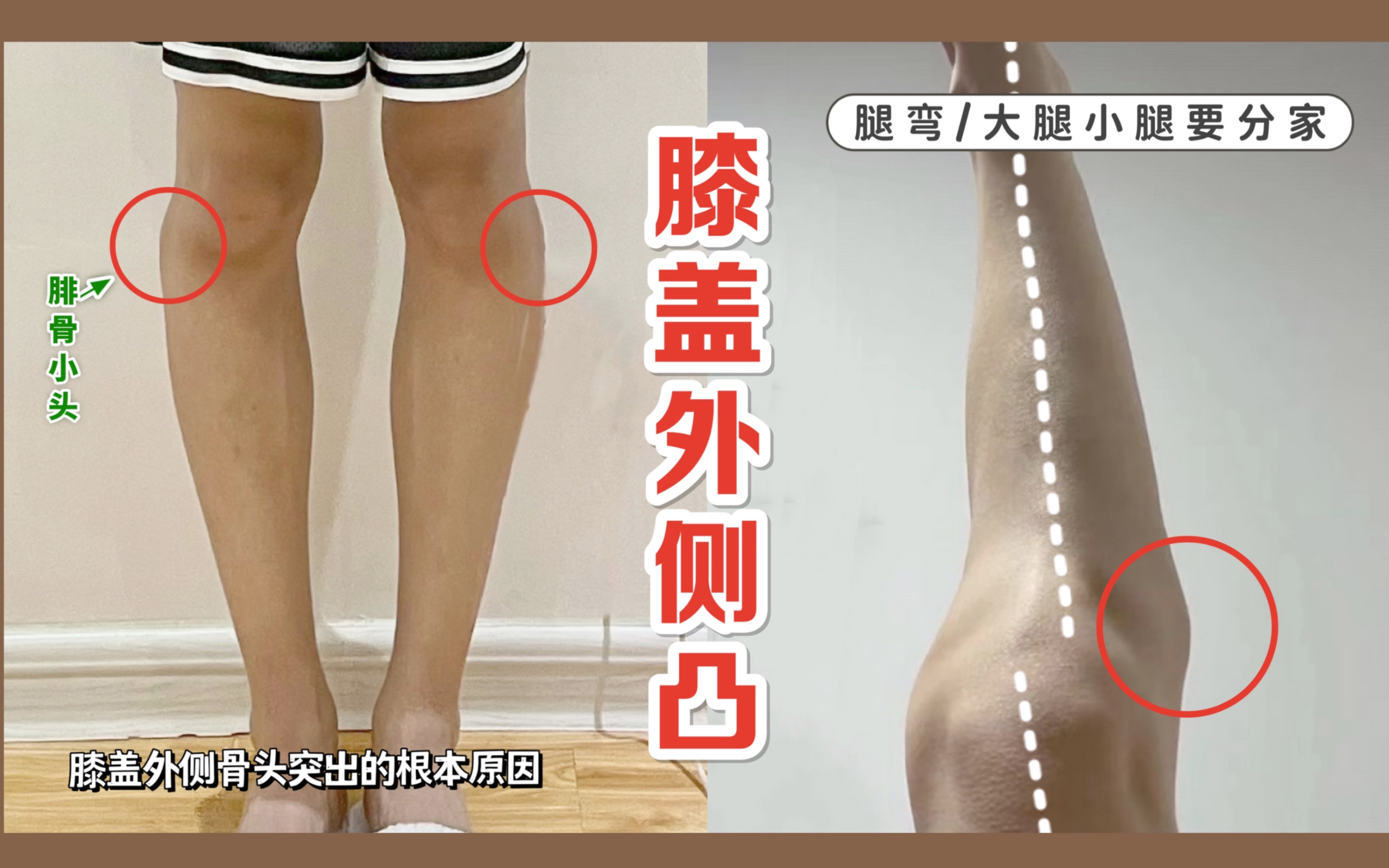 突然大腿中段外侧有一横向肌肉凹陷