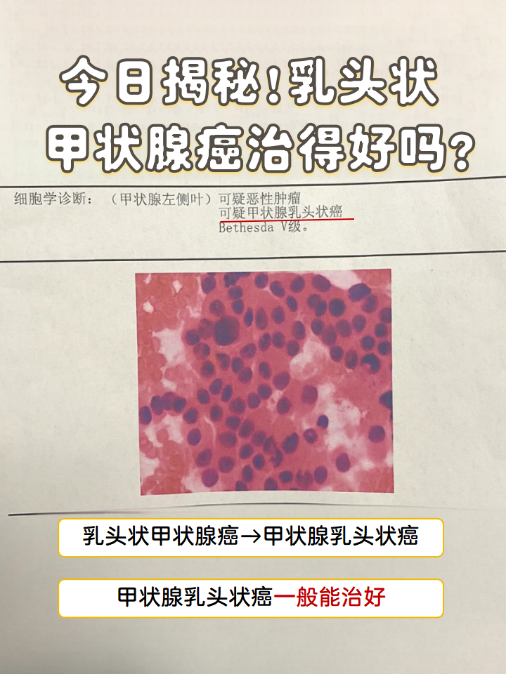 甲状腺癌是什么