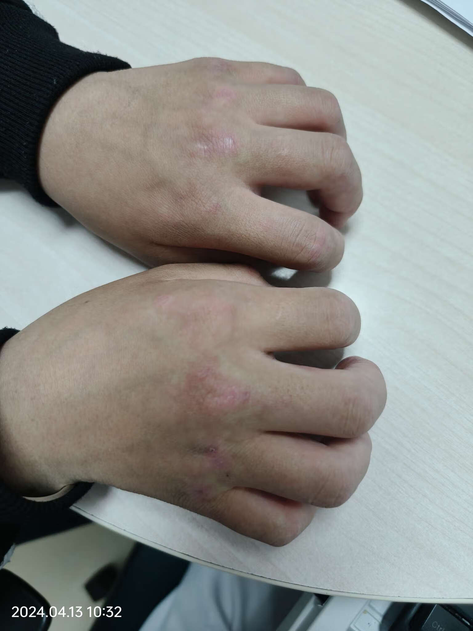 红斑狼疮早期症状有哪些?