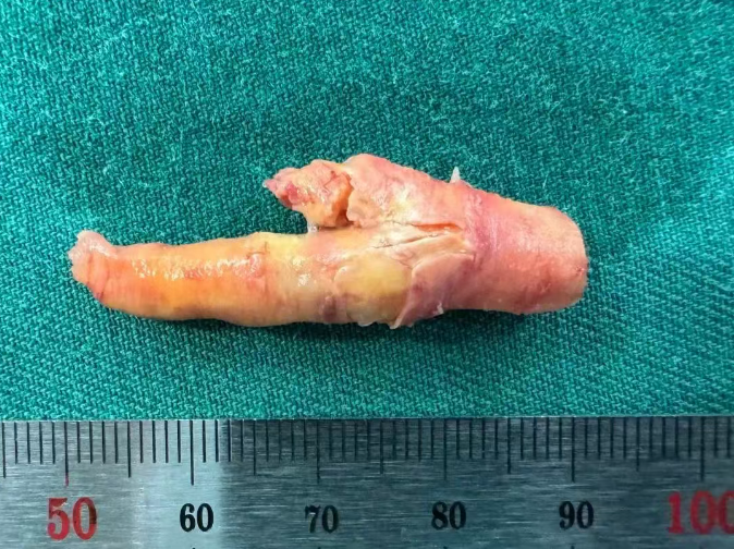 颈动脉内斑块是什么